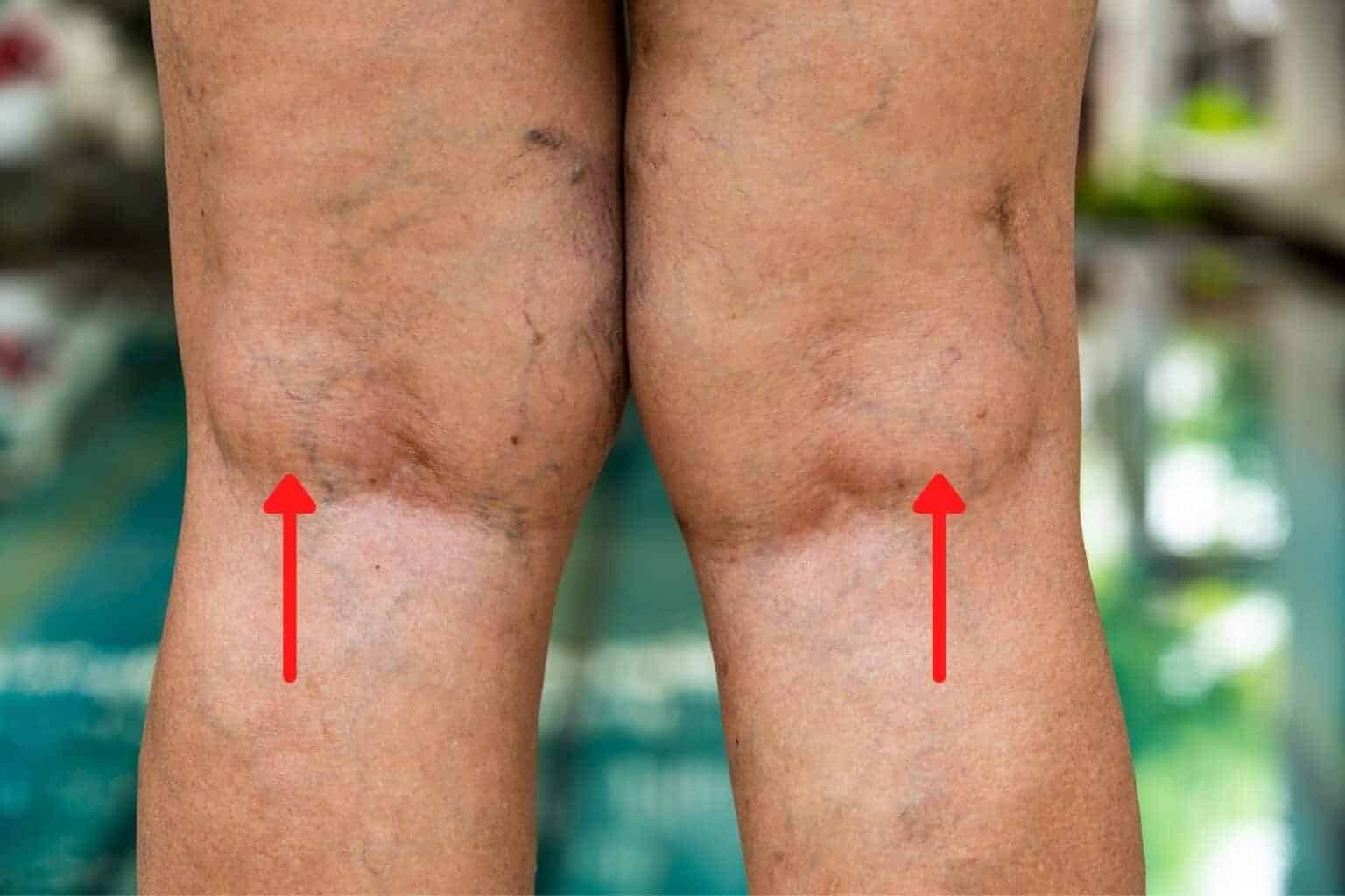 fluid in knee pain