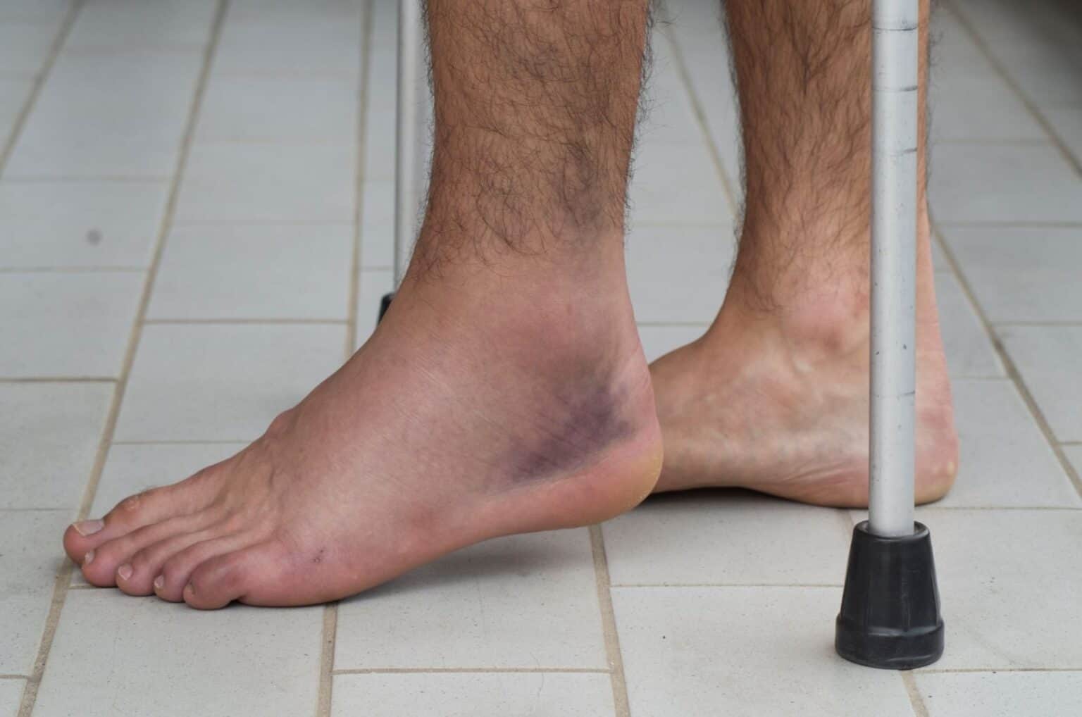 ankle-fracture-before-and-after-buyxraysonline