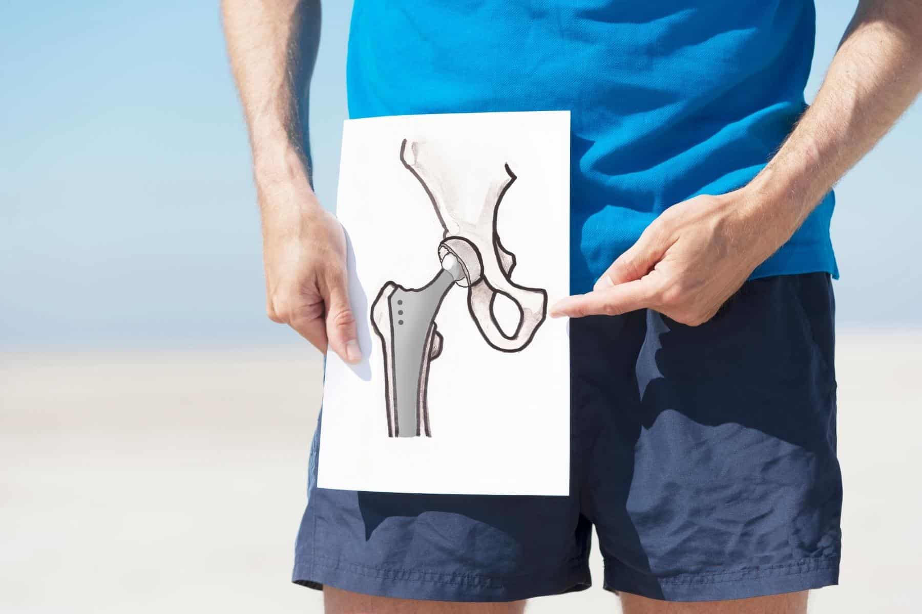 For Active Patients, Anterior Hip Replacement Surgery May Shorten